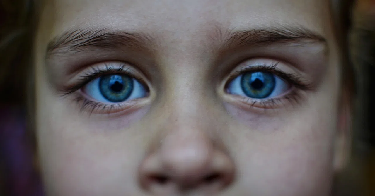 Синдром Лобштейна-ван дер Хове