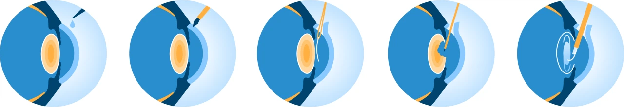 Этапы лечения катаракты