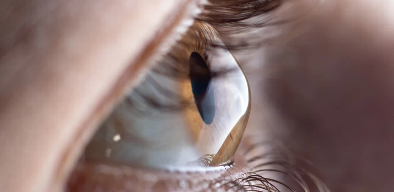 Кератоконус