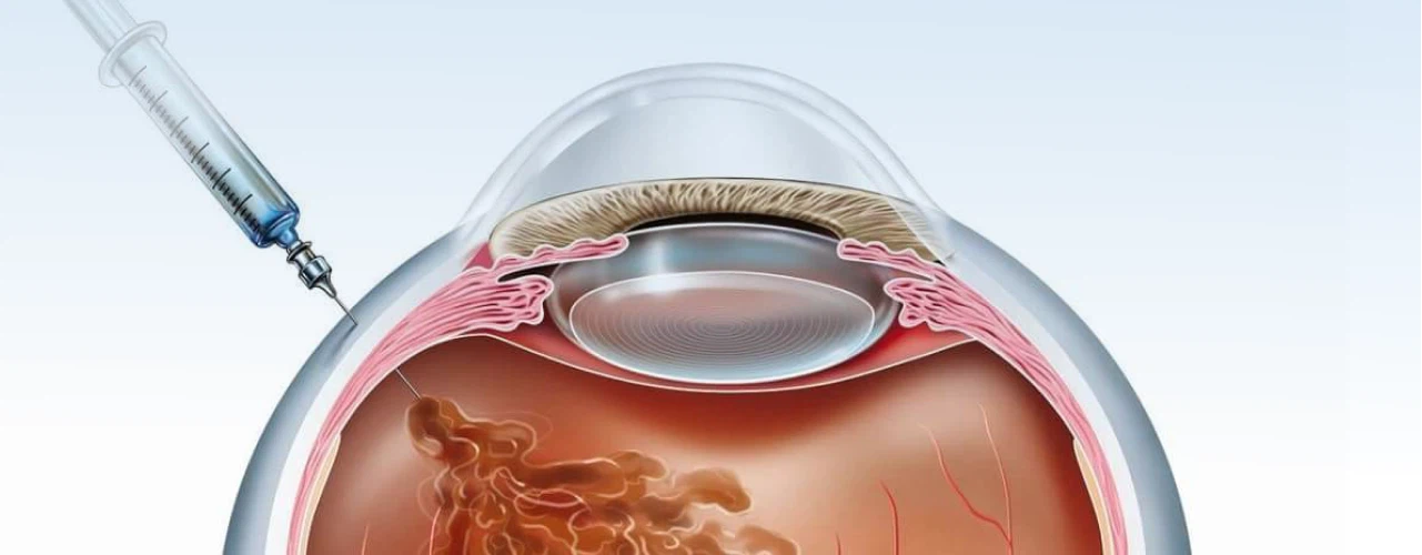 Инъекции в стекловидное тело