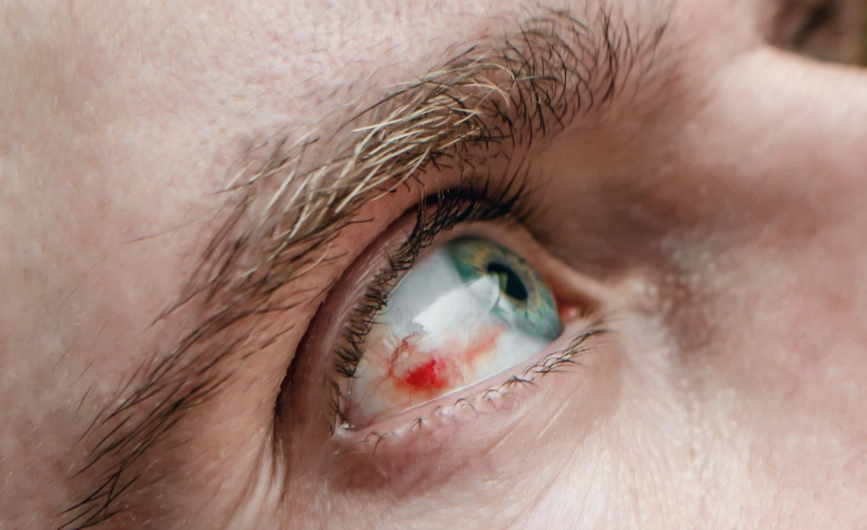 Субконъюнктивальное кровоизлияние