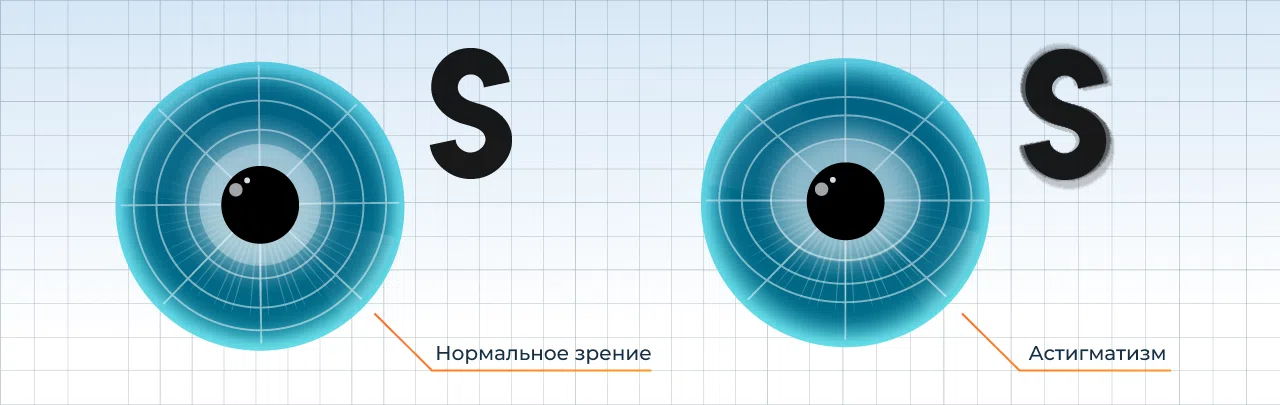Осложнения птеригиума