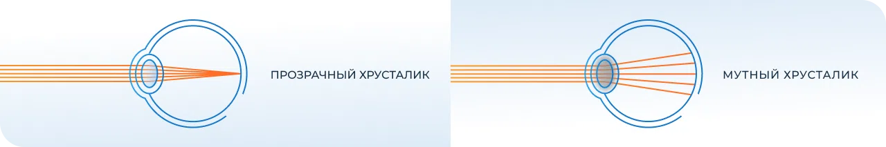 Нетравматические причины вывиха хрусталика