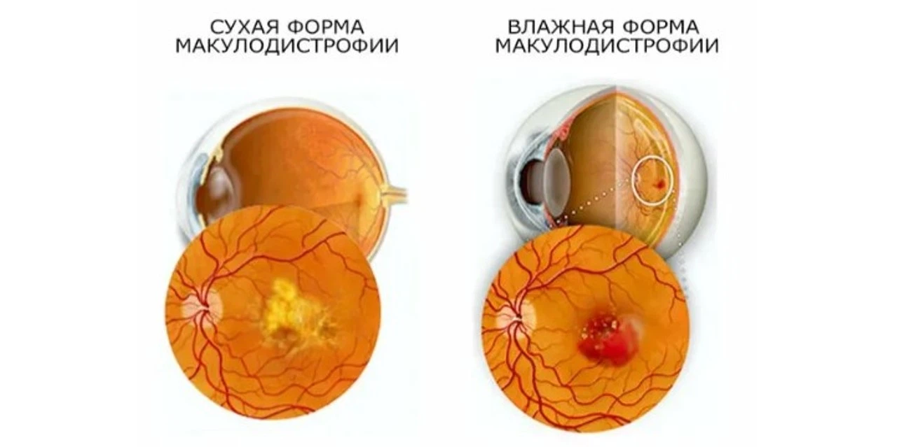 Влажная форма возрастной макулодистрофии