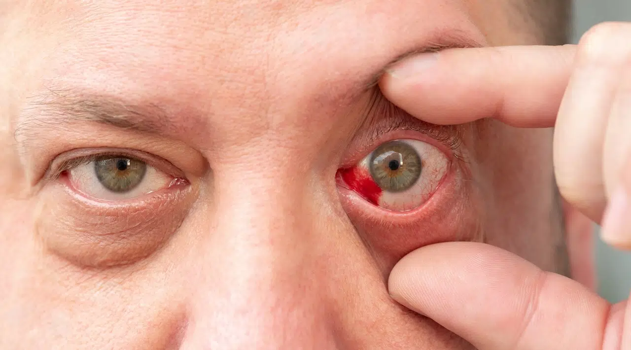 Осложнения ангиосклероза сетчатки