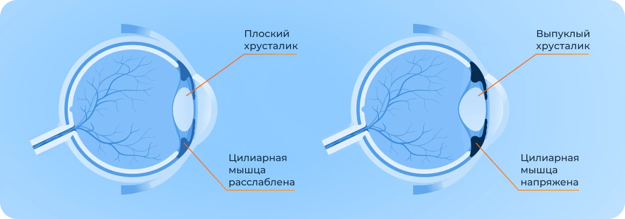 Спазма аккомодации