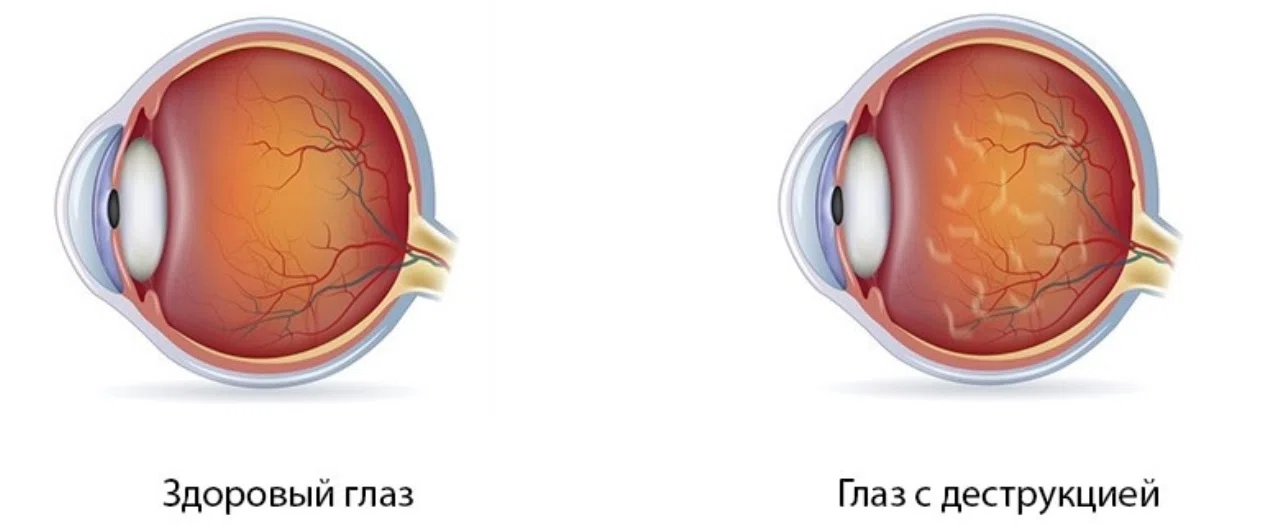 Деструкция стекловидного тела