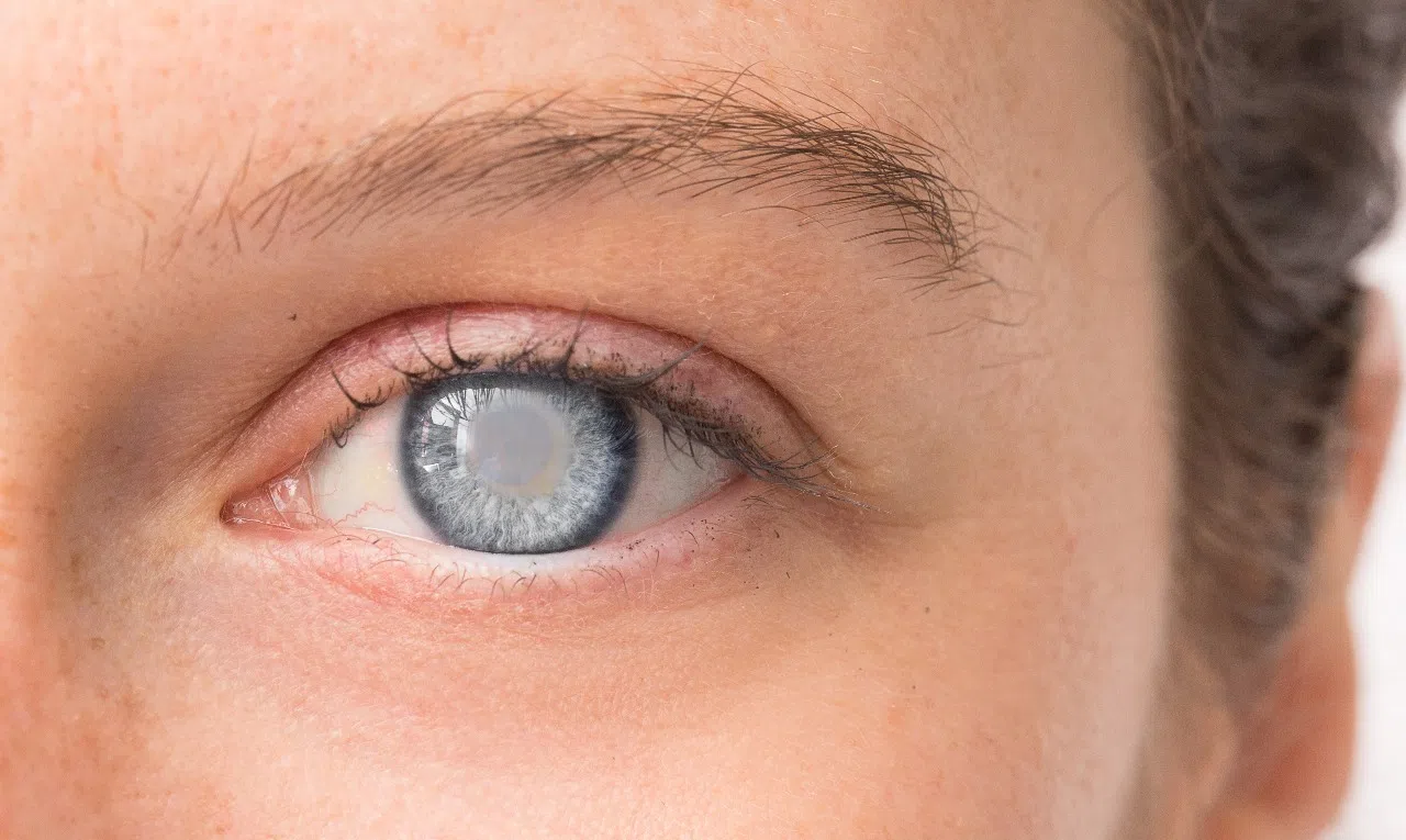 Симптомы травматической катаракты