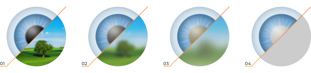 Стадии развития катаракты
