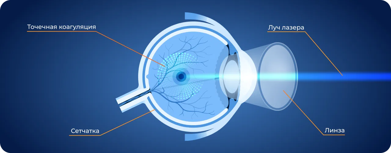 Лазерная коагуляция сетчатки