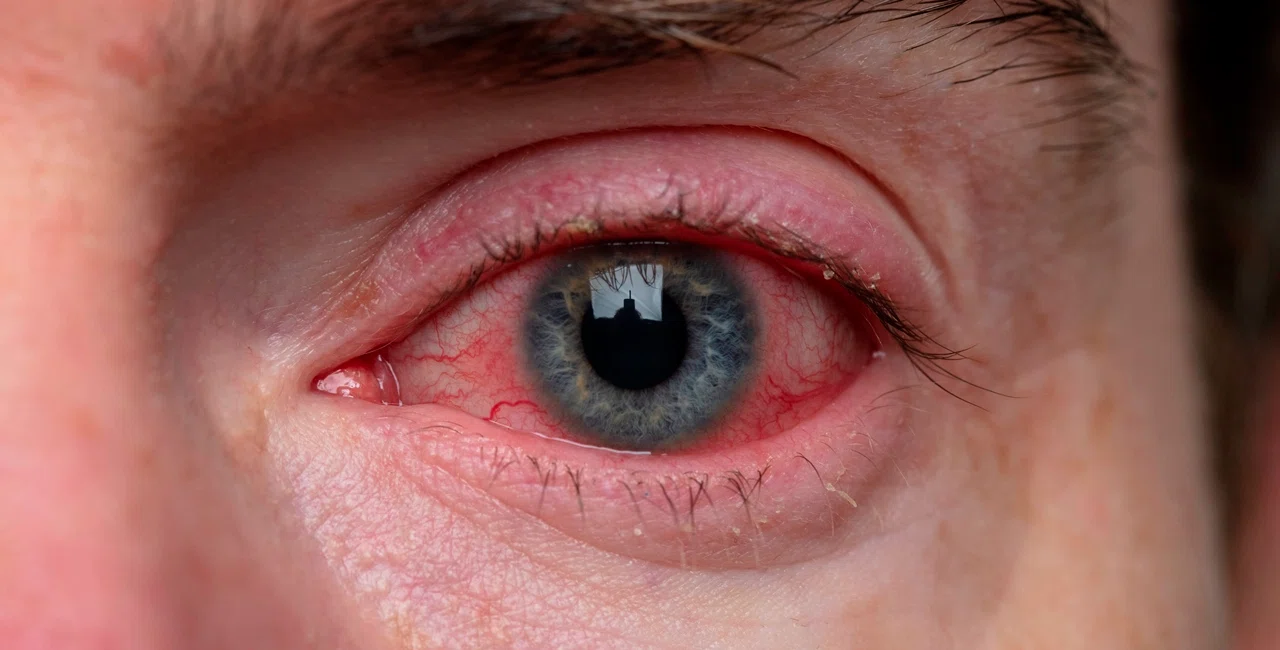 Конъюнктивит