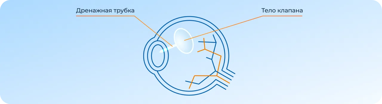 Лечение при глаукоме