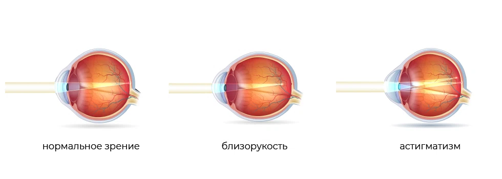 Близорукость и астигматизм
