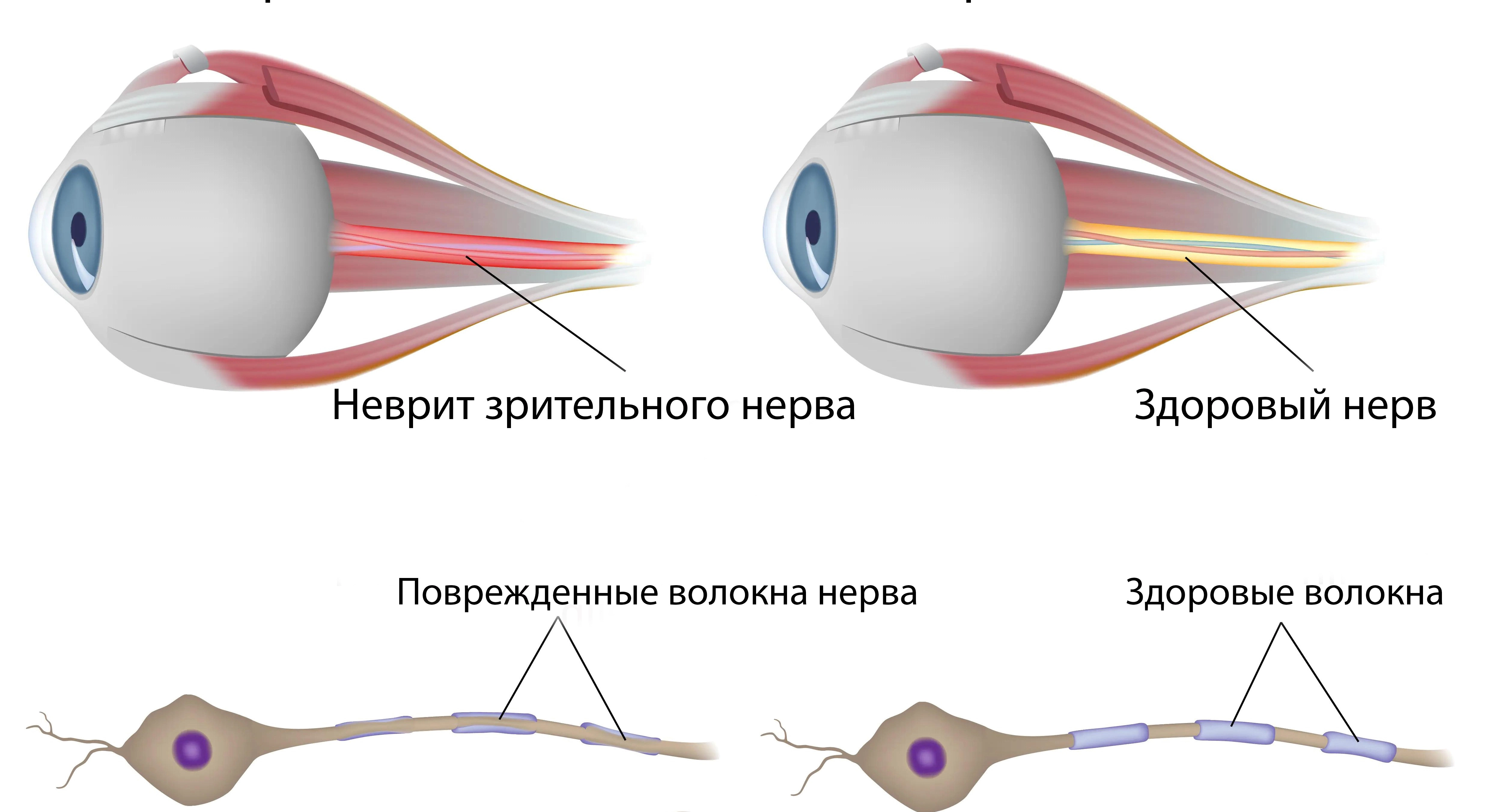 Неврит зрительного нерва