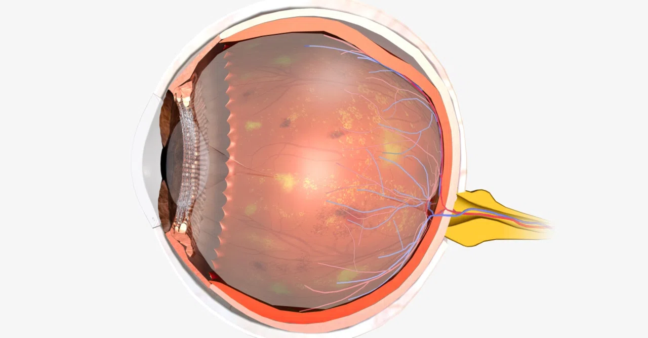 Хориоретинит