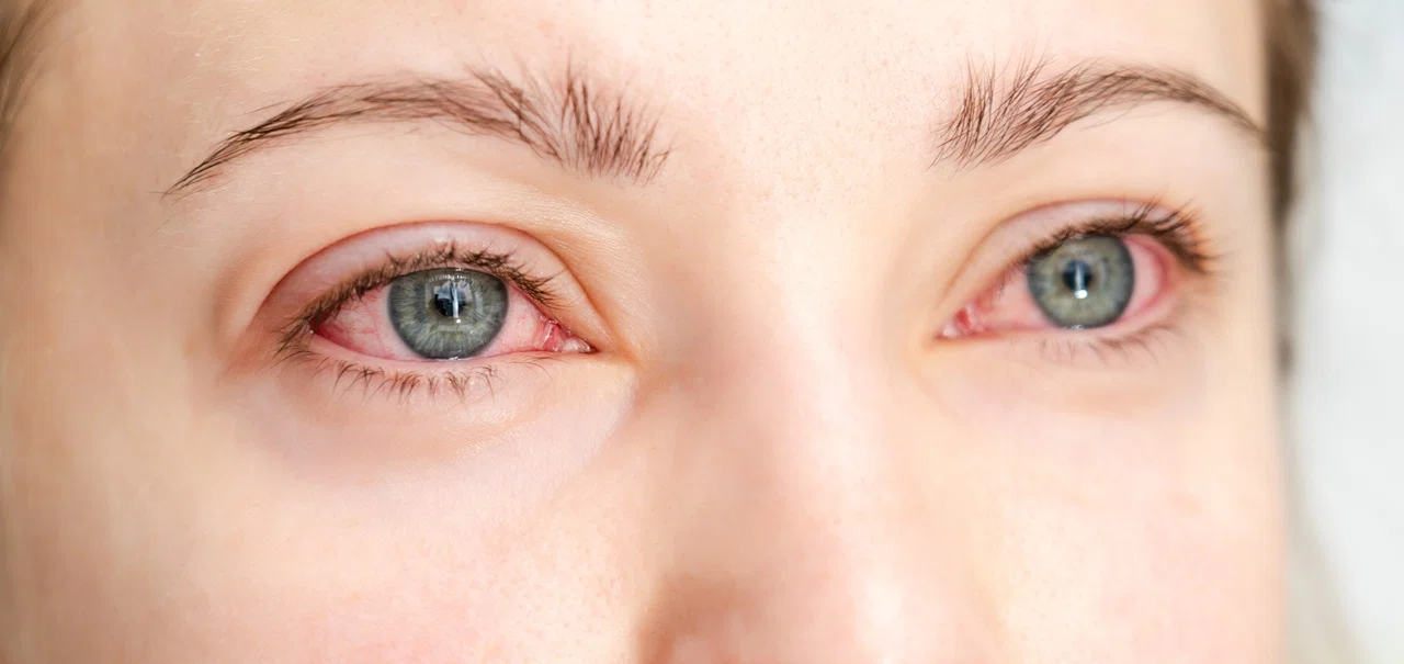 Симптомы дистрофии роговицы