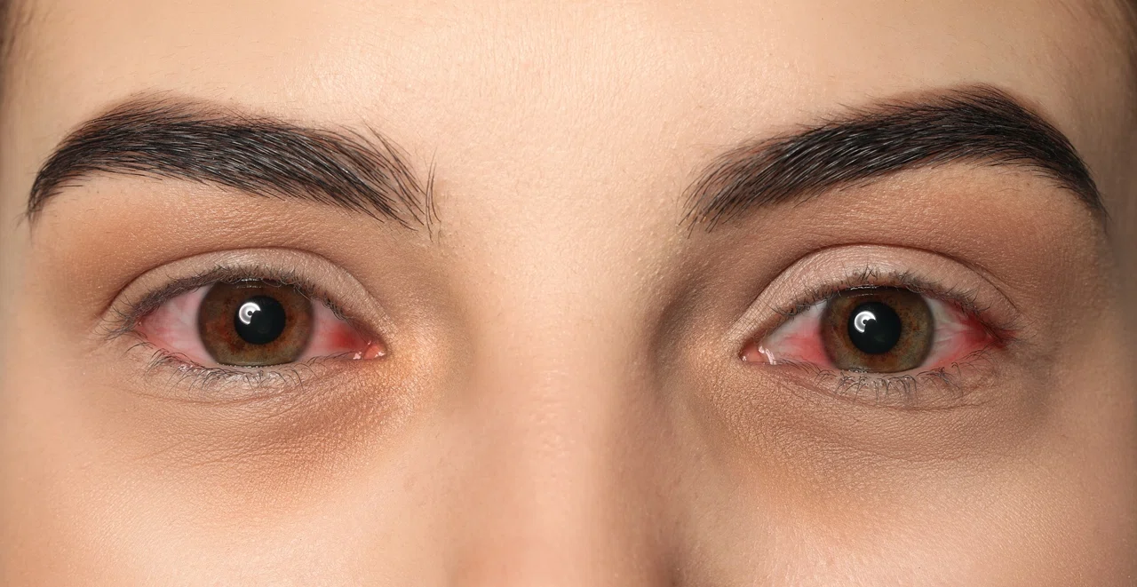 Симптомы эписклерита