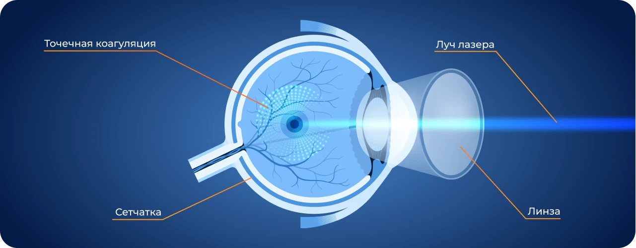 Лазерная коагуляция