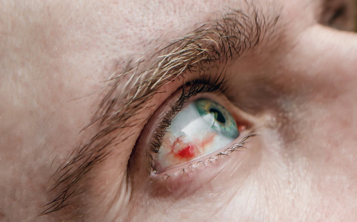 Патогенез ангиопатии сетчатки