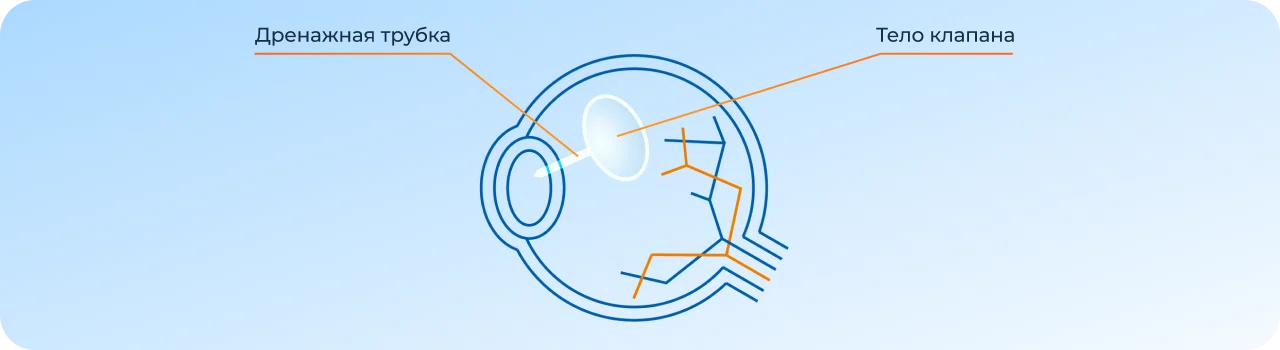 антиглаукомный дренаж ahmed