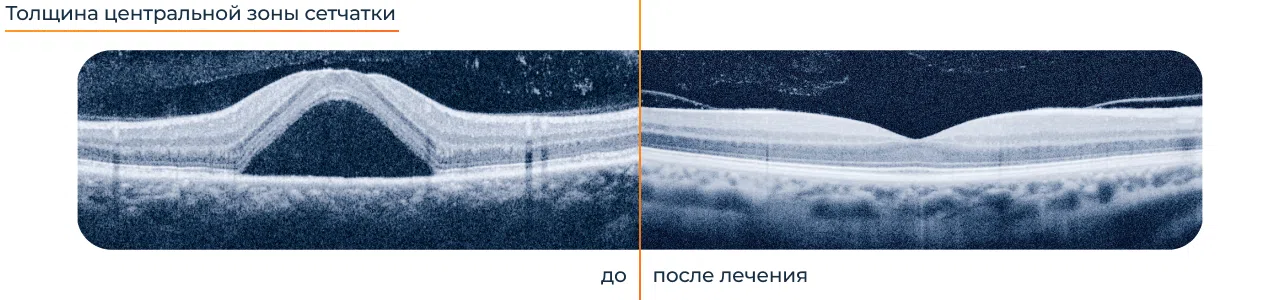 Методы лечения фиброза сетчатки