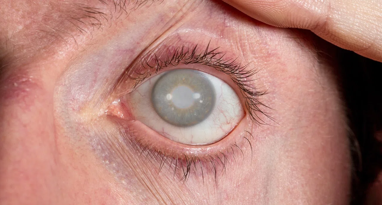 Ядерная катаракта