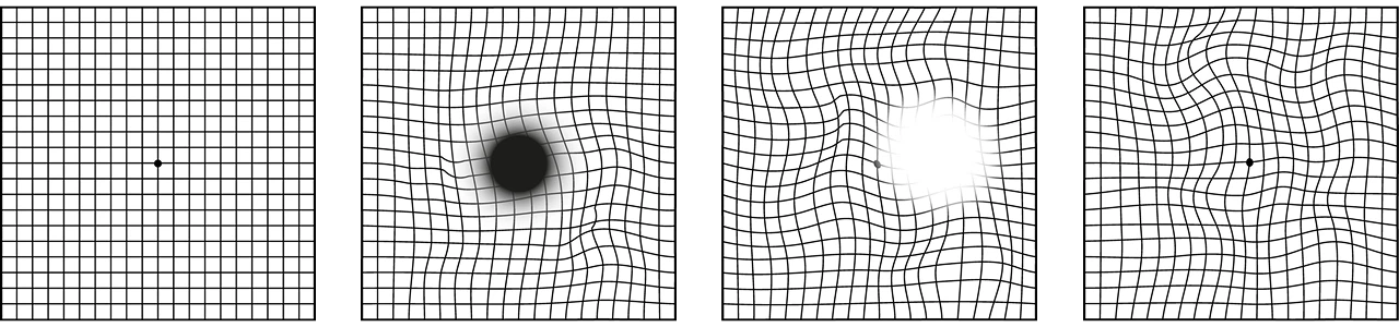 Симптомы атрофии сетчатки