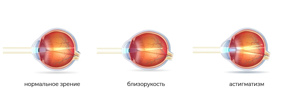 Виды аметропии