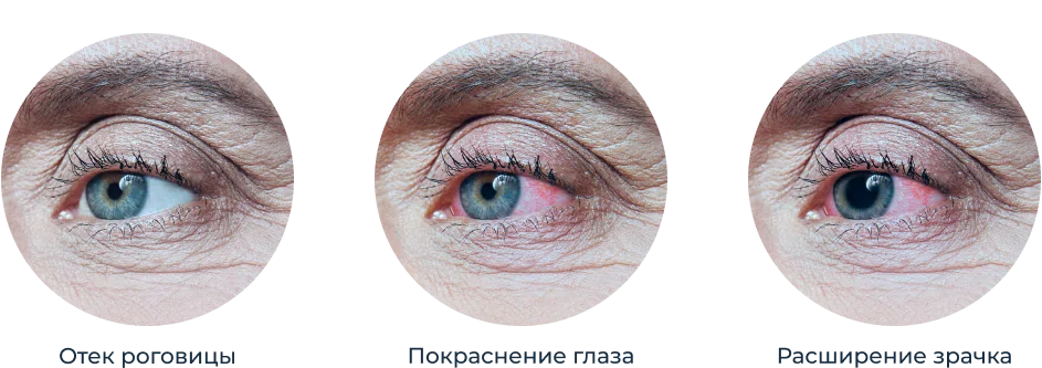 Отек роговицы