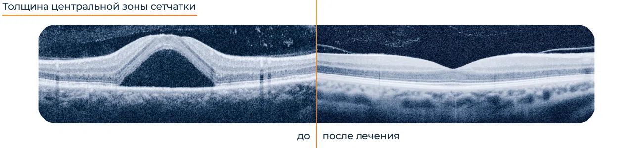 Прогноз лечения ретиношизиса