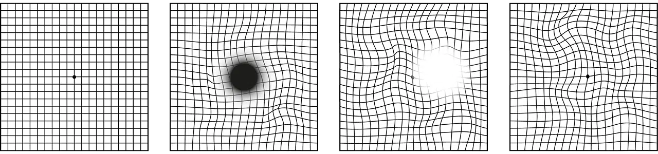 Симптомы фиброза сетчатки