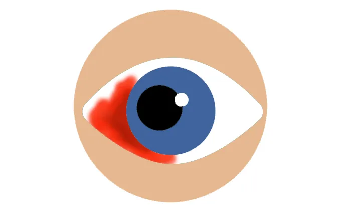 Классификация кровоизлияний