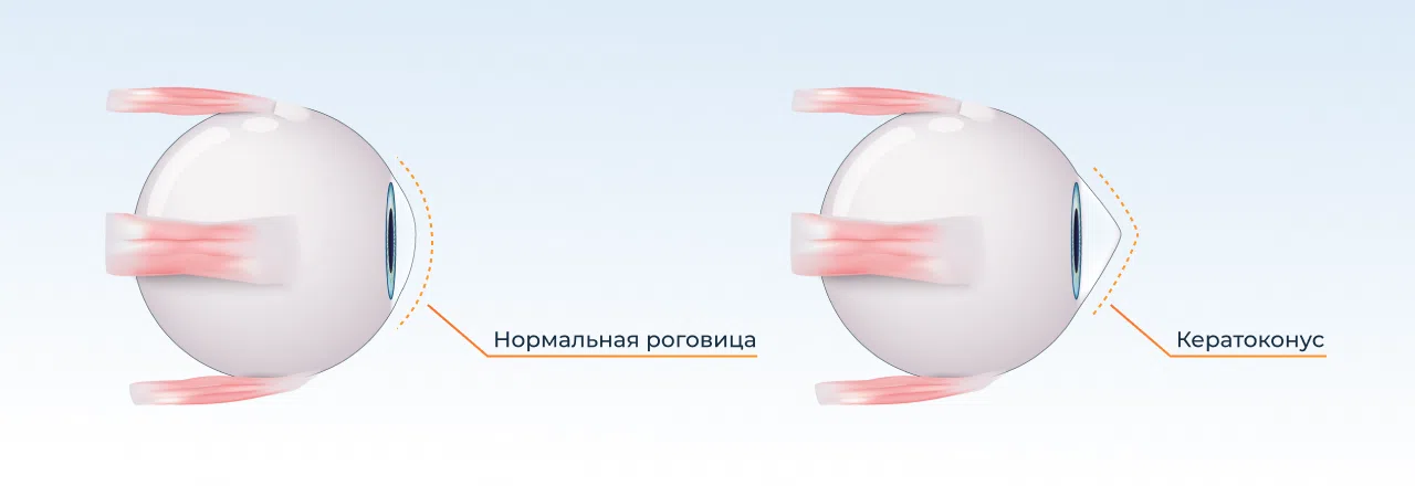 Кератоконус