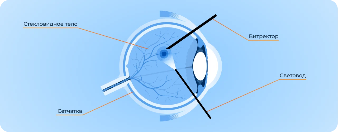 Витрэктомия