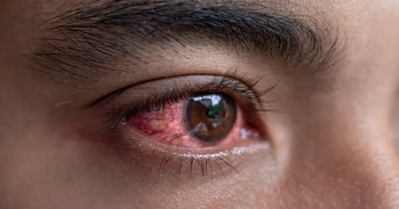 Патогенез синдрома красного глаза