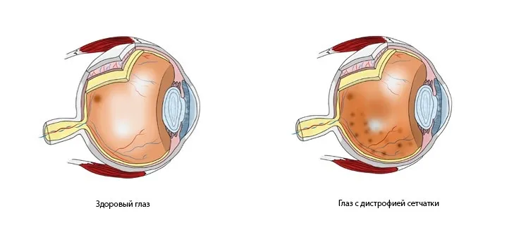 Дистрофия сетчатки