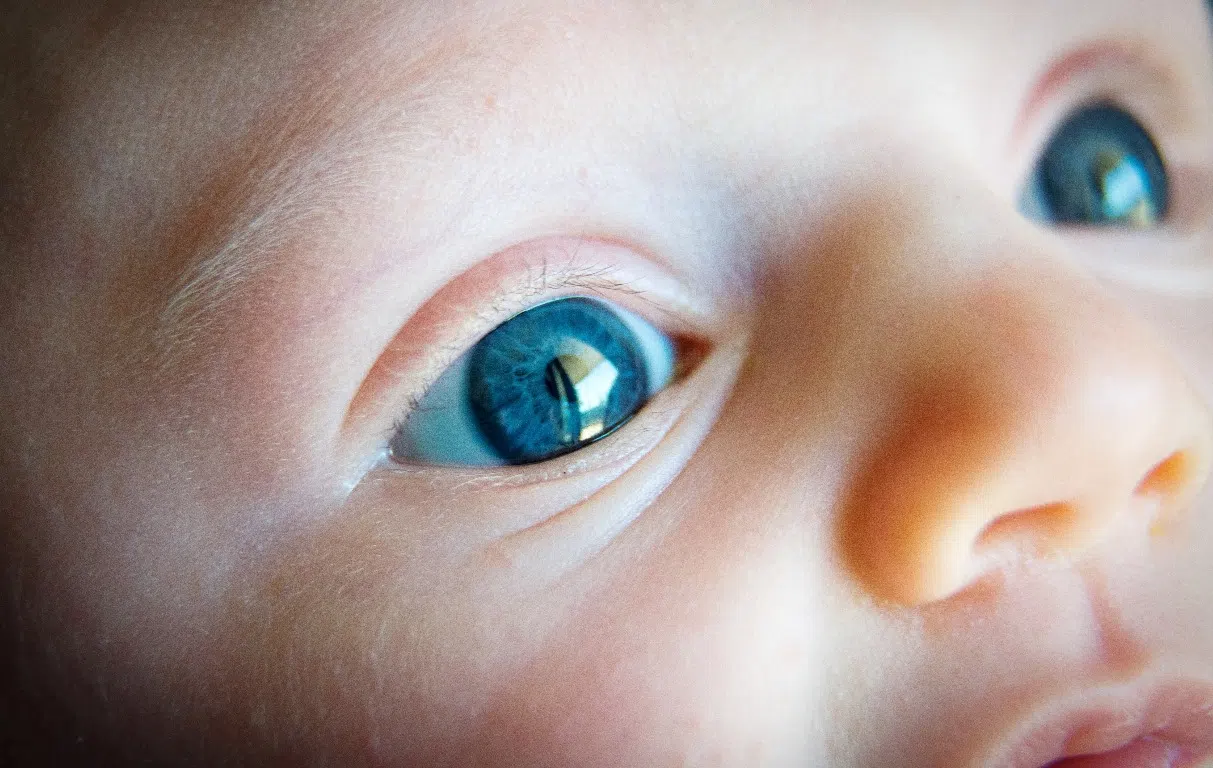 Причины синдрома голубых склер