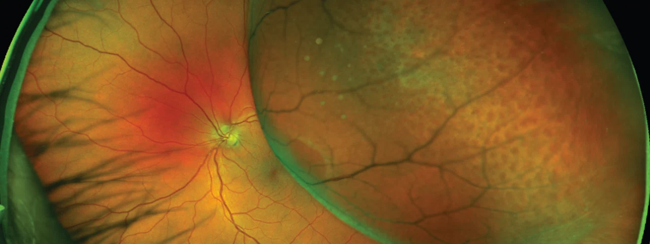 Ретиношизис