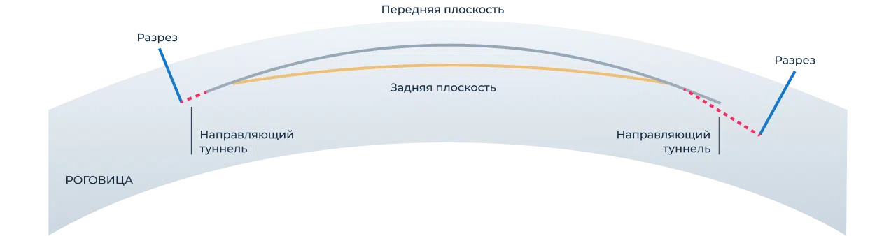 Лазерная коррекция зрения