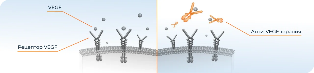 Лечение ангиосклероза сетчатки