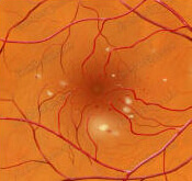 Фоновая ретинопатия сетчатки