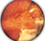 ретинит