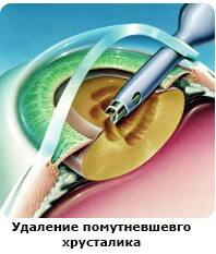 Этапы факоэмульсификации (замена хрусталика глаза при катаракте)